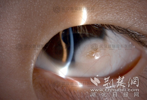 眼睛“小米粒”3年长成“大珍珠”   皮样瘤男童角膜移植术后获光明