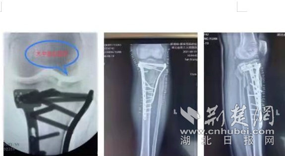 男子高处坠落造成左膝复杂损伤，关节外科成功完成高难度手术