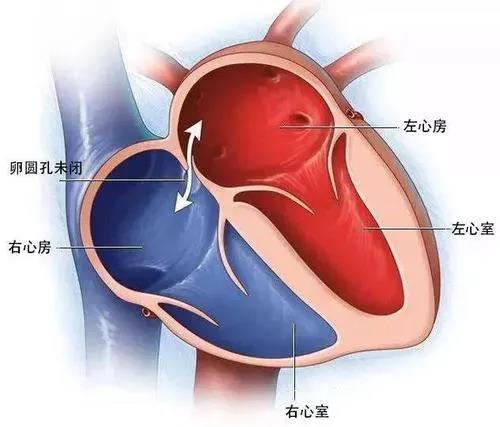 衡阳市中心医院完成首例单一胸壁超声引导下经皮介入PFO封堵术