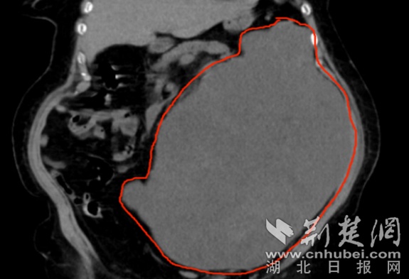 太婆腹腔藏13斤重巨大肿瘤  湖北省中医院胃肠外科精准“拆弹”