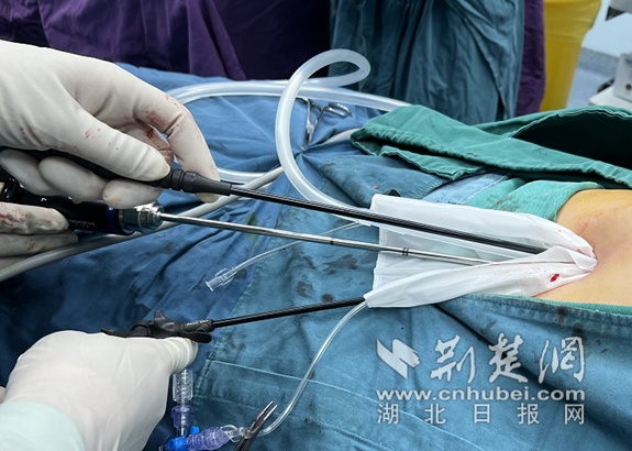 华中首例！微创4.0时代单孔免气腹手术在普仁医院成功开展