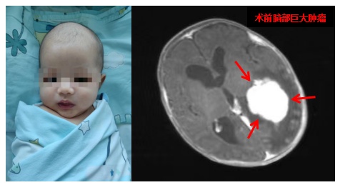 巨大脑肿瘤45天患儿获救！吉大一院新生儿科多学科协作救治年龄最小巨大颅脑肿瘤患儿